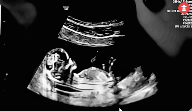 NubCheck is a free tool where you can easily draw the lines and calculate the angle on an ultrasound image.