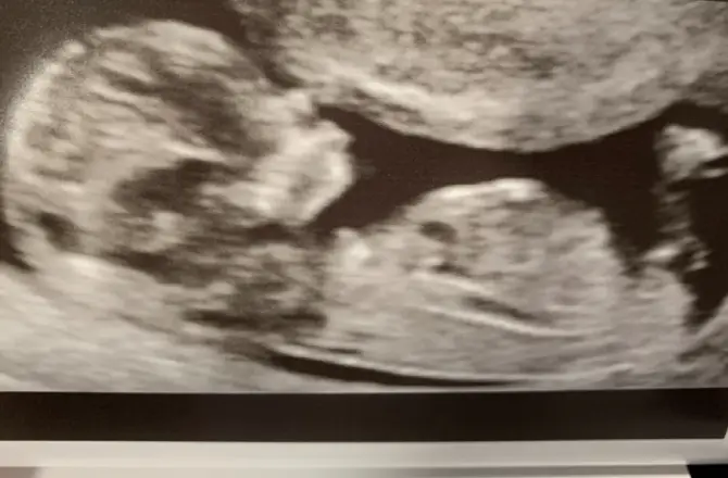 Boy Prediction at 13 Weeks