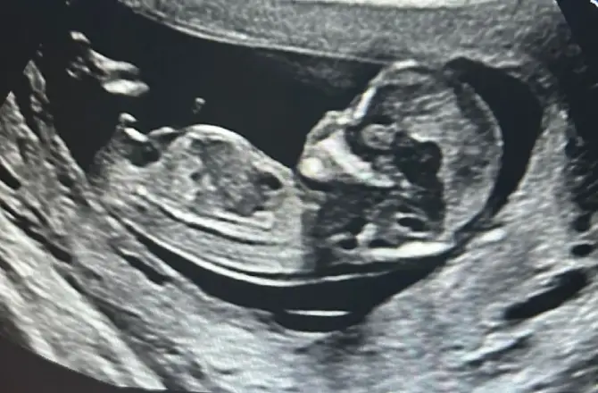 Boy Nub Example (12 Weeks + 5 Days)