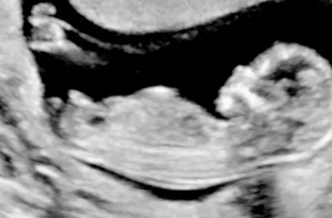 Nub Theory Boy Example (11 Weeks + 6 Days)