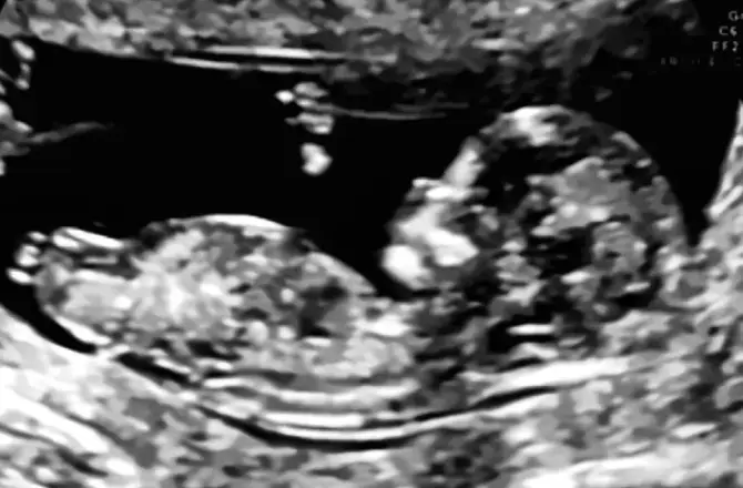 Clear Girl Nub Example (12 Weeks + 4 Days)
