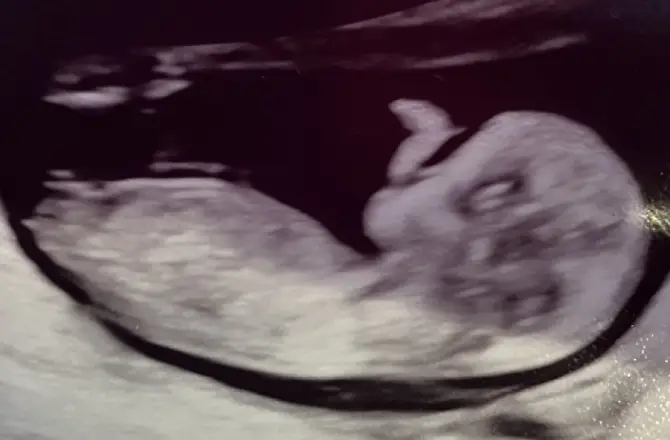 Girl Prediction at 13 Weeks