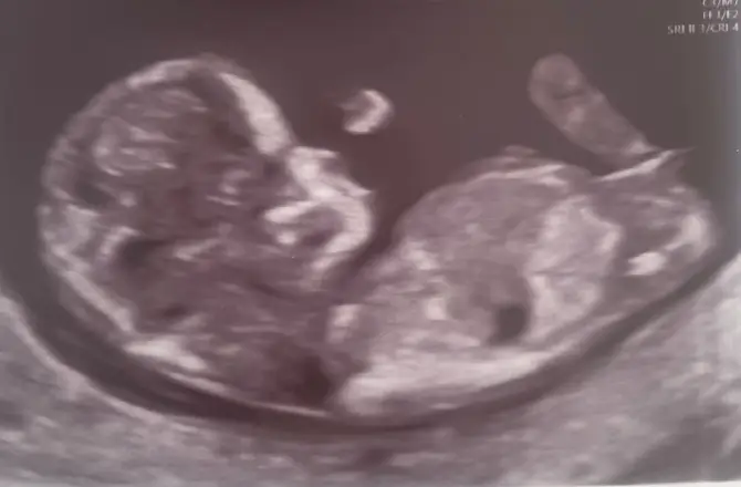 Girl Nub Example (12 Weeks + 2 Days)