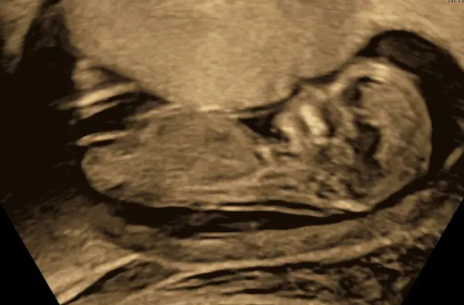 Nub Theory Girl Example (13 Weeks)